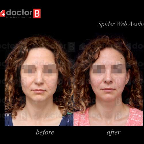 صور قبل وبعد لمرضانا - الجراحة التجميلية - د. مرفة أوفلاز
